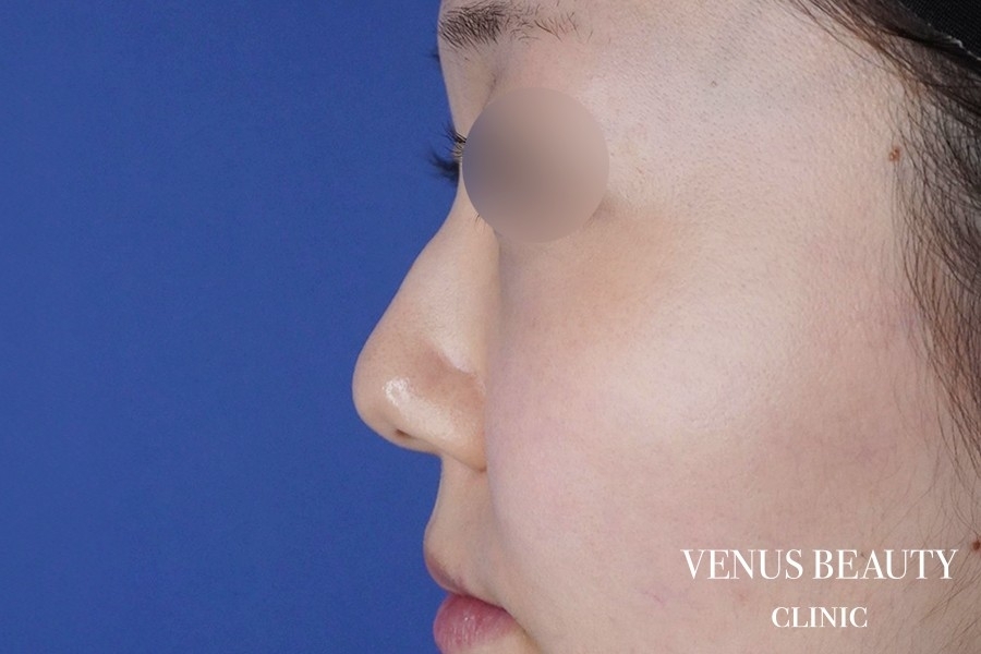 鼻中隔延長 施術前