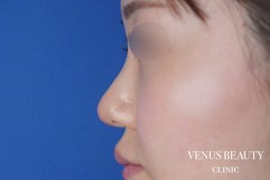 鼻中隔延長 施術後