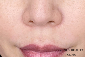 人中短縮術 施術前