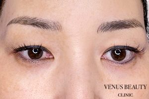 眉下切開(眉下リフト) 施術前