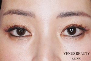 眉下切開(眉下リフト) 施術後