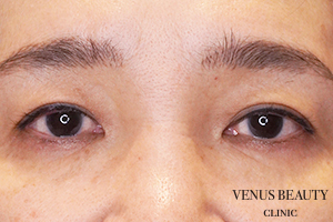 眉下切開(眉下リフト) 施術前