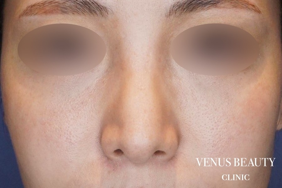 骨切幅寄せ 施術後