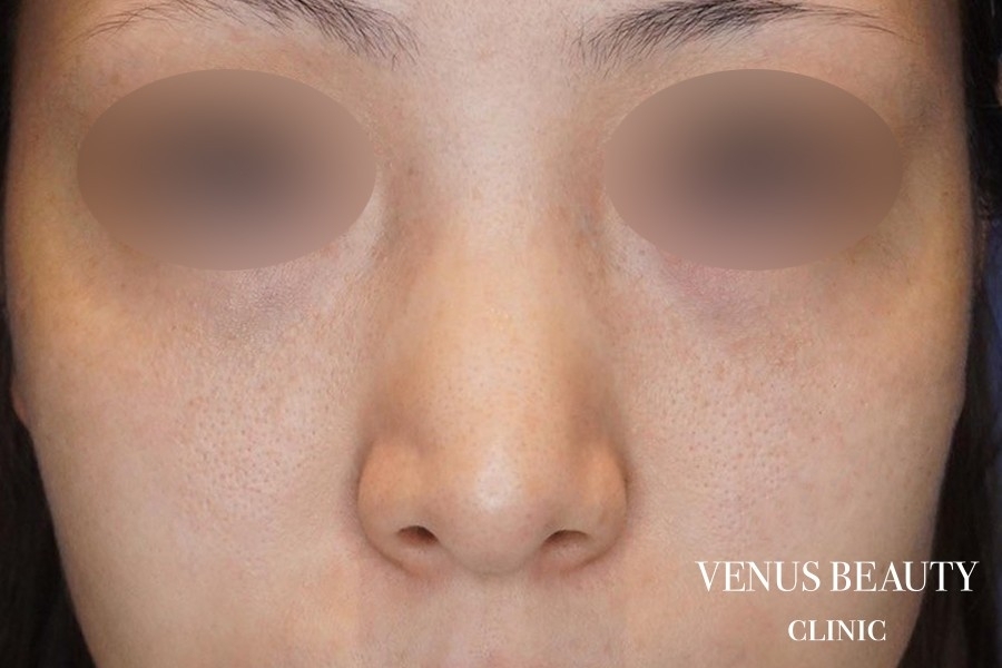 骨切幅寄せ 施術前