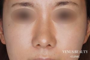 鼻中隔延長 施術後