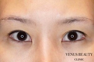 目尻切開 施術前