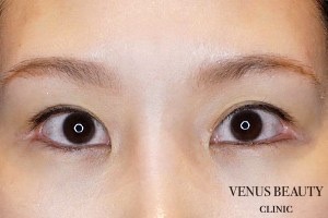 目尻切開 施術後