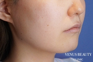 口角挙上 施術前