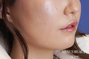 口角挙上 施術後