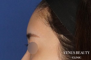 脂肪注入 施術後