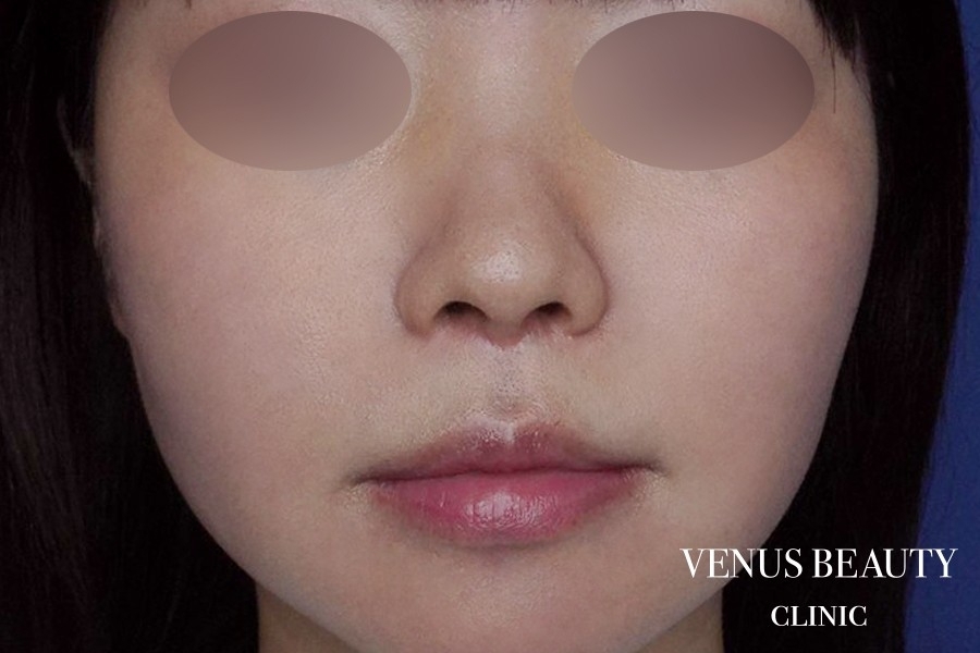 人中窩形成 施術後