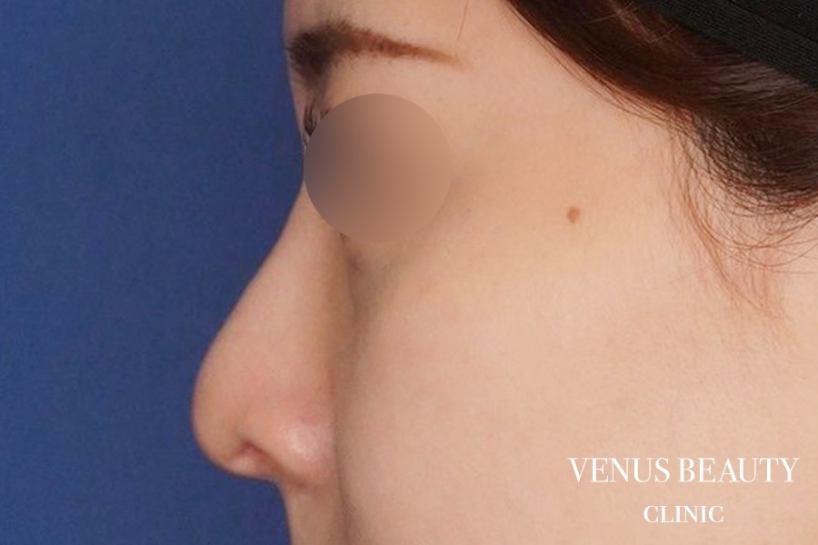 耳介軟骨移植 施術後