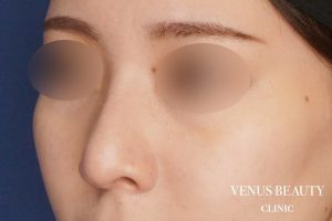 耳介軟骨移植 施術後