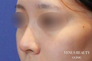 耳介軟骨移植 施術前