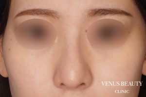 鼻尖形成 施術後