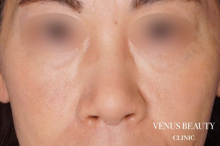 鼻尖形成 施術後