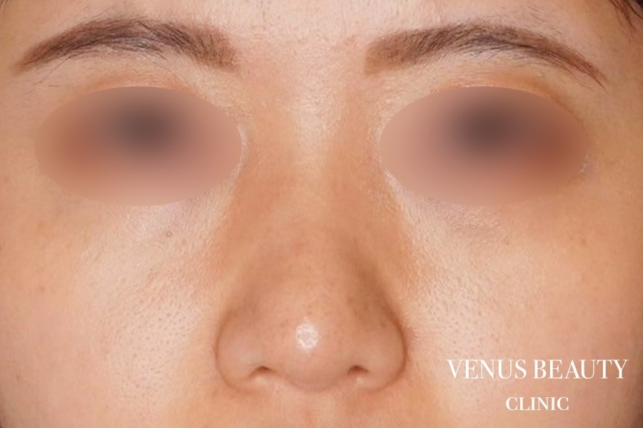 鼻尖形成 施術後