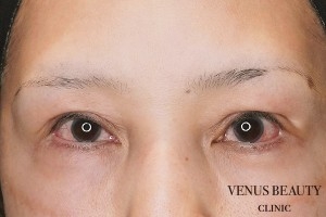 下瞼開大術（グラマラスライン） 施術前