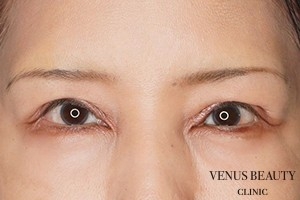 下瞼開大術（グラマラスライン） 施術後
