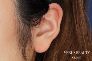 耳たぶ縮小術 施術前