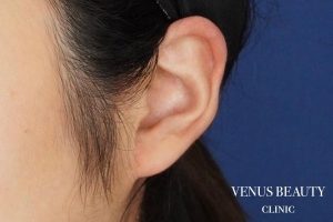 耳たぶ縮小術 施術後