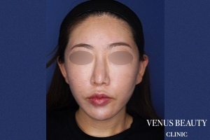 ネックリフト 施術後