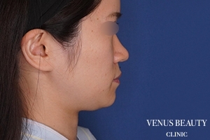 糸リフト+脂肪吸引 施術前