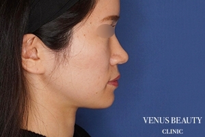 糸リフト+脂肪吸引 施術後