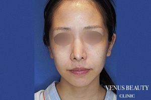 フルフェイスリフト 施術前