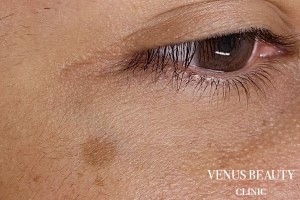 ピコレーザー 施術前