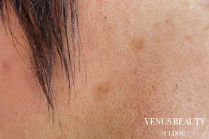 ピコレーザー 施術前