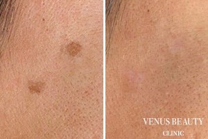 ピコレーザー 施術後