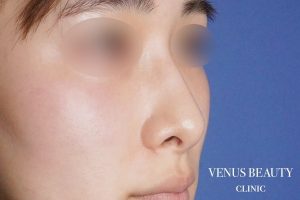 鼻孔縁軟骨移植 施術前