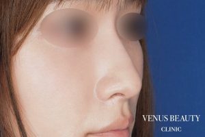 鼻孔縁軟骨移植 施術後