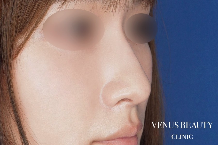 鼻孔縁軟骨移植 施術後