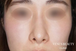 鼻孔縁軟骨移植 施術前