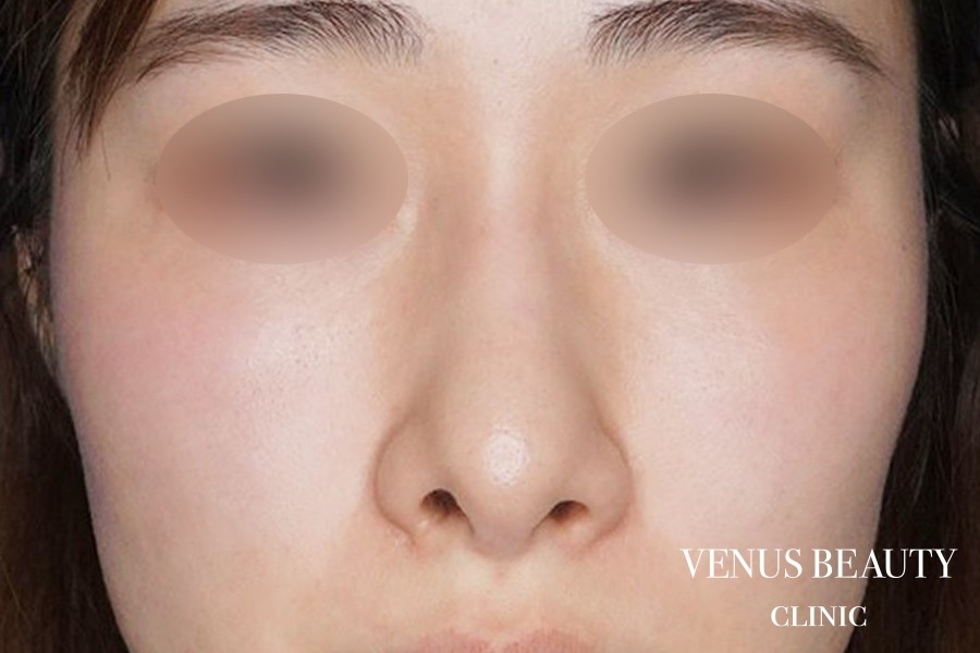 鼻孔縁軟骨移植 施術前