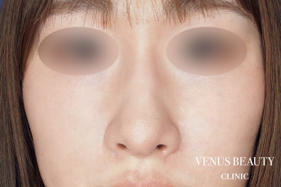 鼻孔縁軟骨移植 施術後