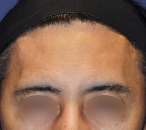 額リフト 施術前