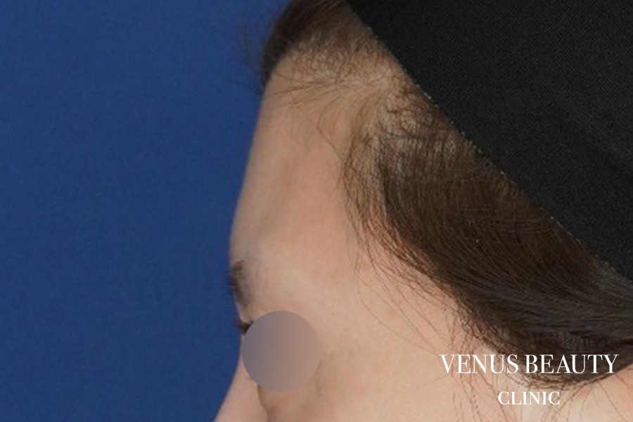 脂肪注入 施術前