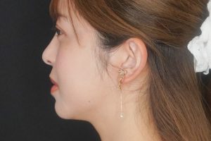 糸リフト 施術後