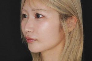 糸リフト 施術後