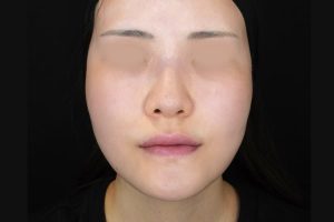 糸リフト 施術後