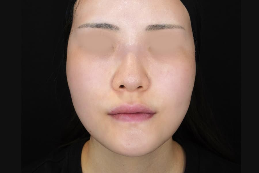 糸リフト 施術後