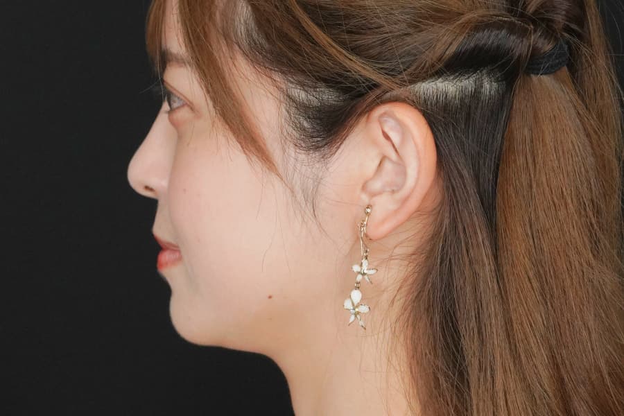 糸リフト 施術前