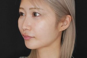 糸リフト 施術前