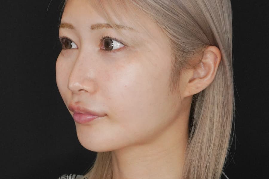 糸リフト 施術前