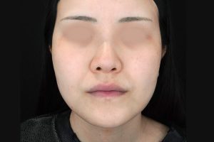 糸リフト 施術前