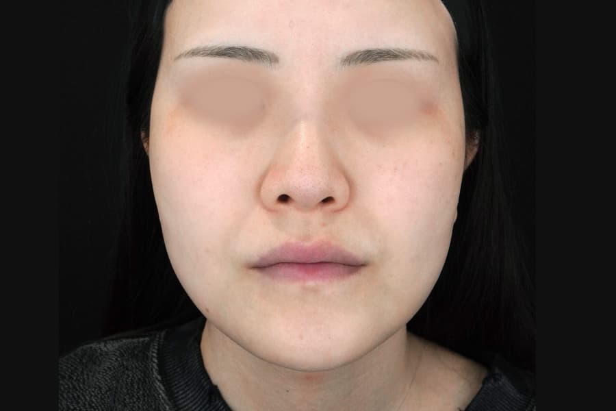 糸リフト 施術前