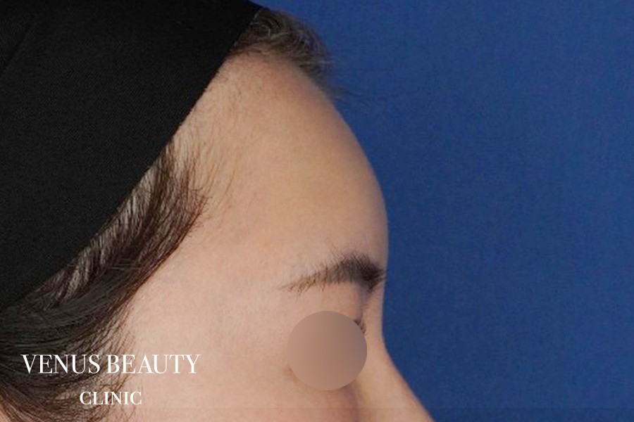 脂肪注入 施術後